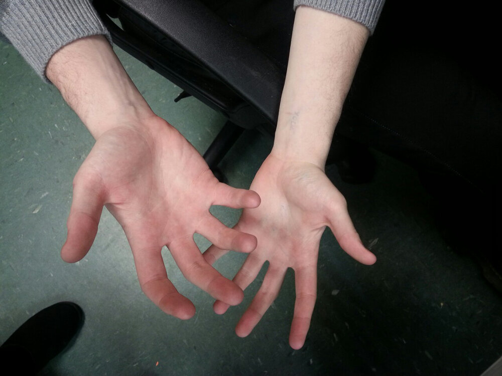 Photograph of two hands with palms open.