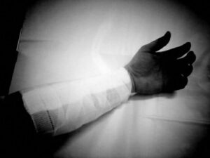 Black and white photo of bandaged arm resting on top of white sheet.